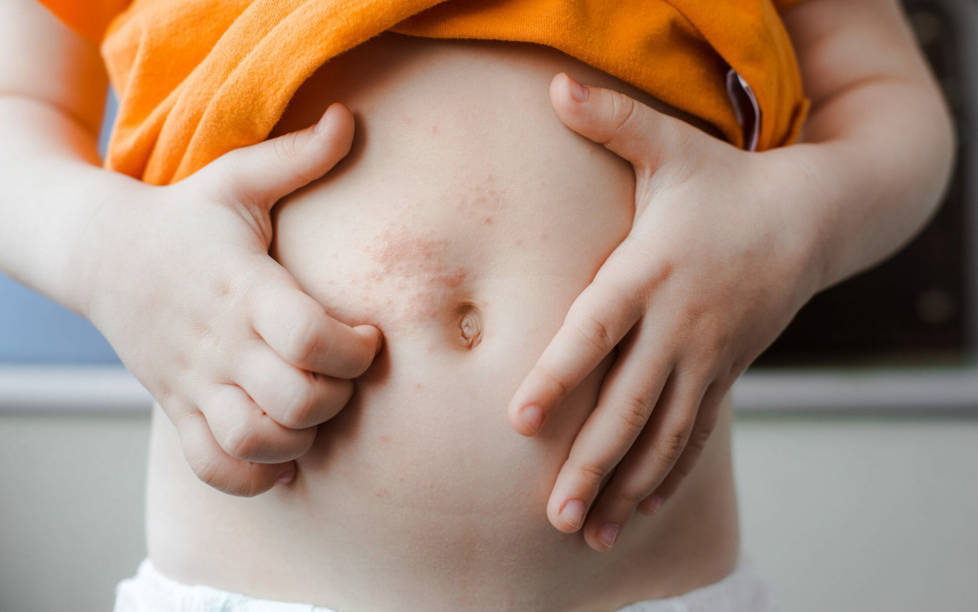 Close up of chickenpox rash on baby's stomach