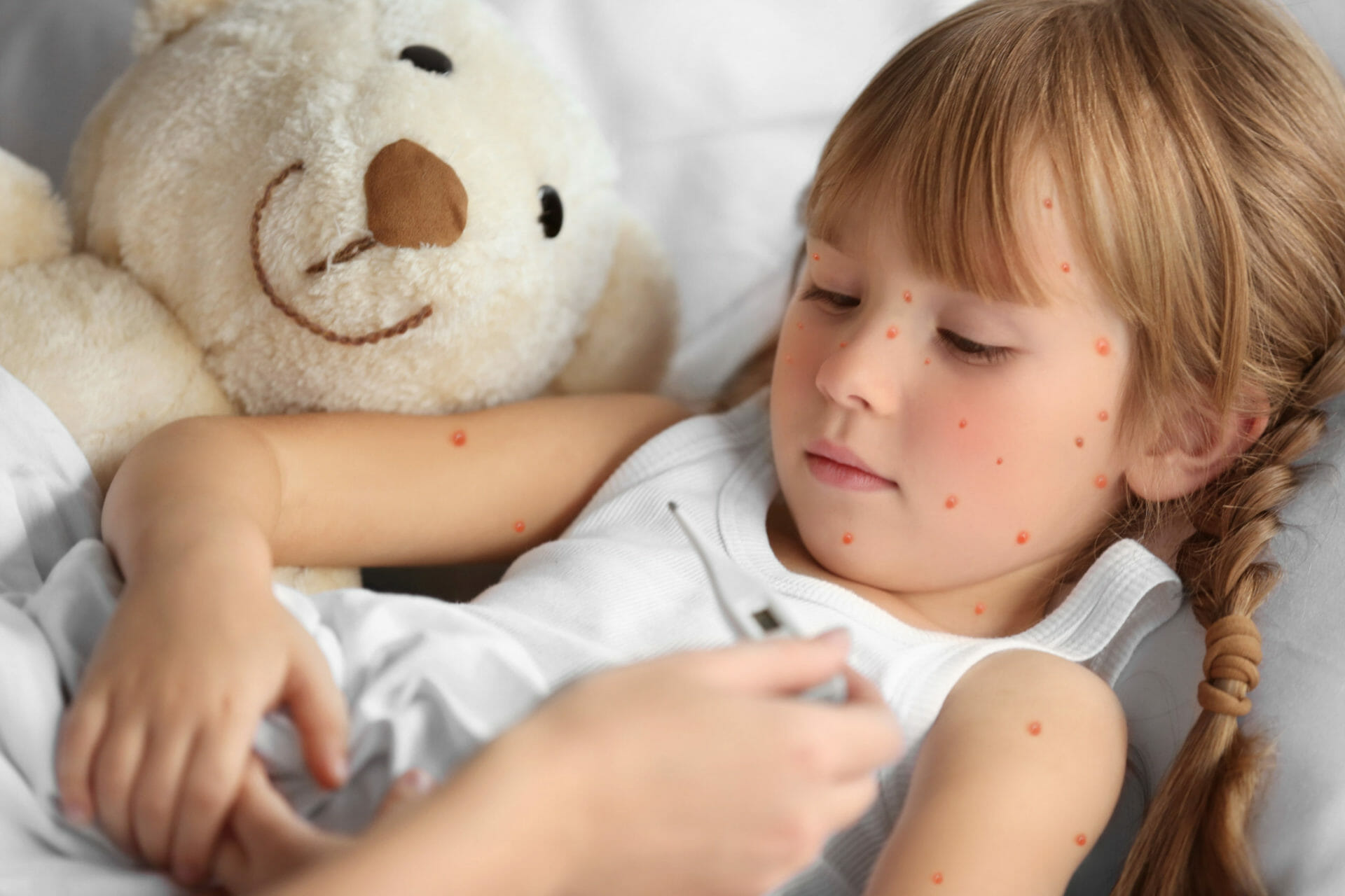 Little girl with chickenpox